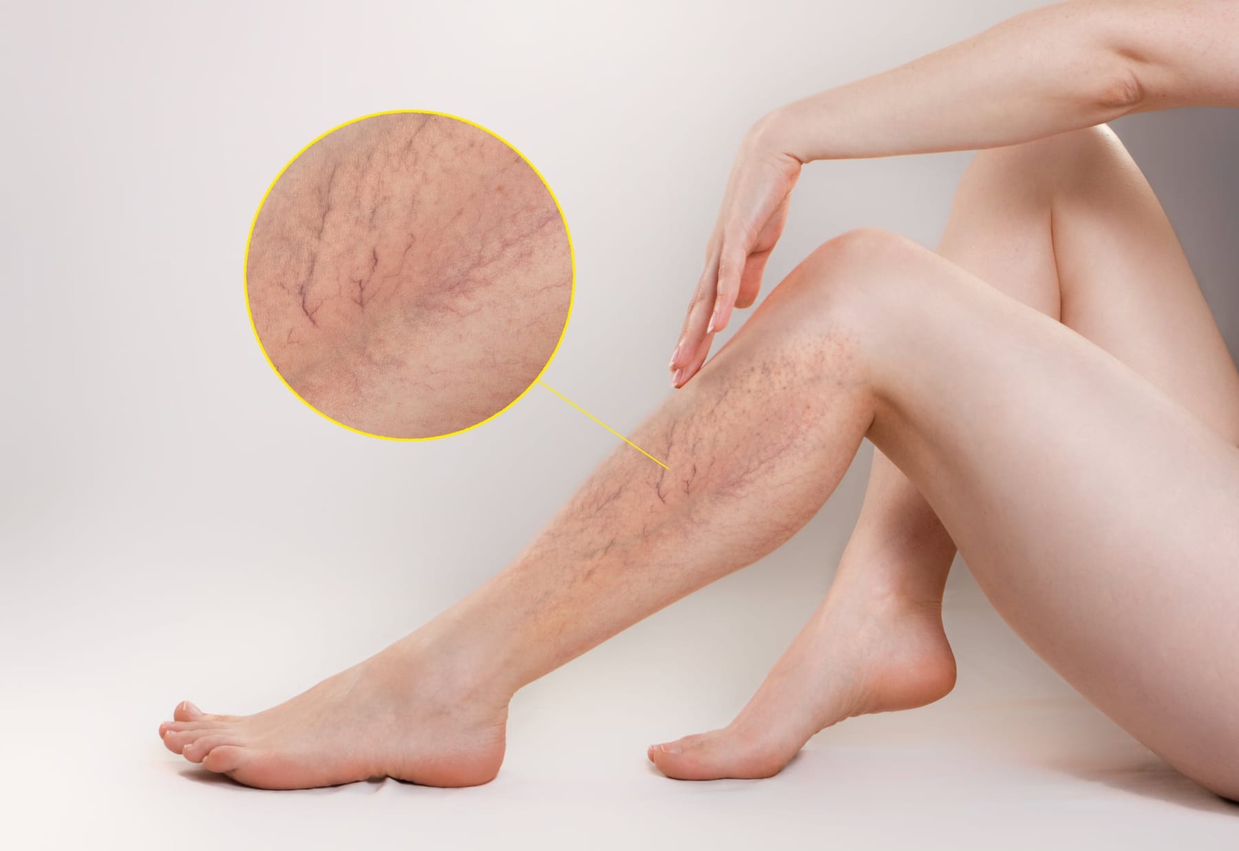 Varicose and Spider Vein Treatment