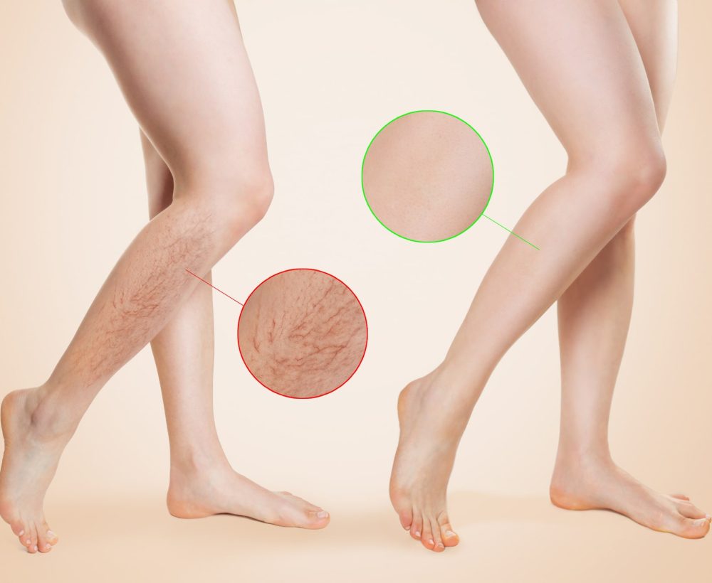 A woman's legs undergo laser treatment, resulting in visible improvement before and after the procedure.