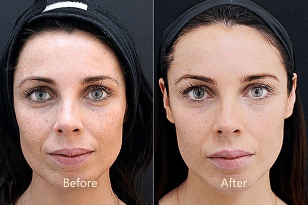 Before and after photos of a woman's face.