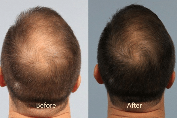 A man's hair before and after a hair transplant.